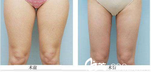 韓政憲院長吸脂瘦腿真人案例