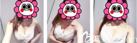 韓國UMNAGUMO整形外科嚴順燦自體脂肪隆胸真人案例術(shù)后十五天 韓國UMNAGUMO整形外科嚴順燦自體脂肪隆胸真人案例術(shù)后十五天