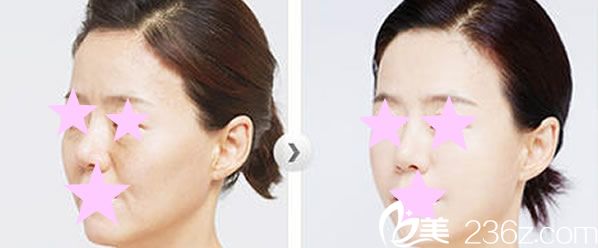 崔院長自體脂肪面部填充效果案例