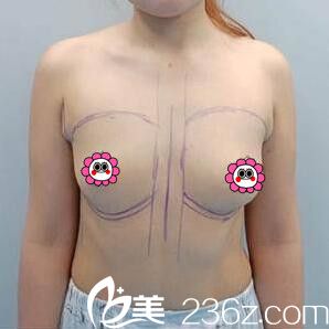 做假體隆胸術(shù)前照 做假體隆胸術(shù)前照