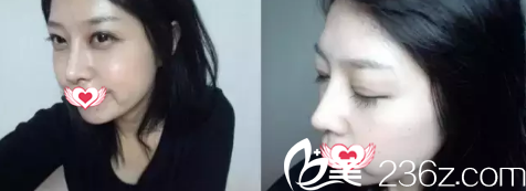 雙眼皮和隆鼻16天完全消腫