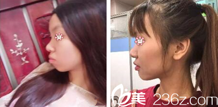 金日秀院長齙牙矯正案例 金日秀院長齙牙矯正案例