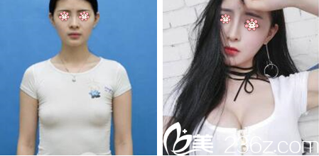 李祐誠(chéng)院長(zhǎng)假體隆胸案例 李祐誠(chéng)院長(zhǎng)假體隆胸案例