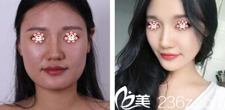 李炳烈院長下頜角整形案例 李炳烈院長下頜角整形案例