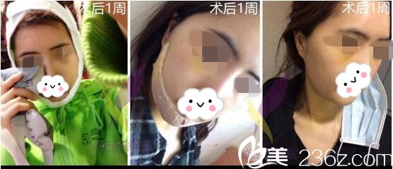 術(shù)后第五天