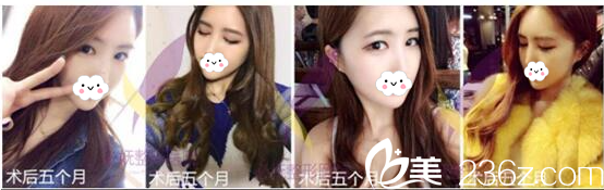 選擇面部輪廓三件套后竟然會(huì)有這樣的結(jié)果，看我在韓國(guó)必嫵醫(yī)院從大餅?zāi)樀叫臉的蛻變過程