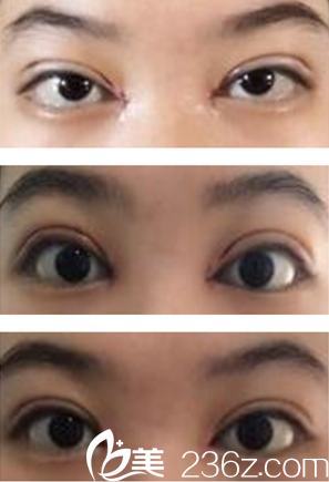 我的雙眼皮恢復(fù)過程