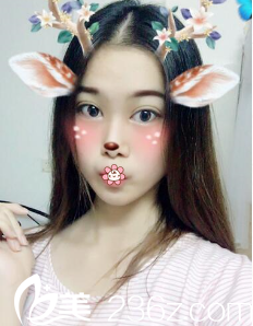 李祐誠韓式雙眼皮術(shù)后19天