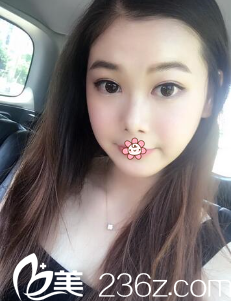 韓國ROSE整形外科雙眼皮術(shù)后一個月