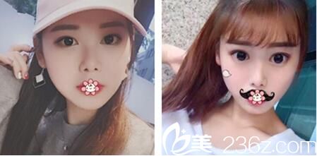 韓國ROSE整形外科李祐誠雙眼皮術(shù)后三個月