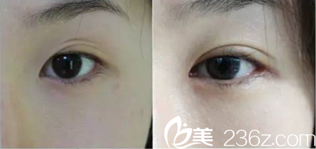 廉沅錫院長三眼皮修復(fù)案例