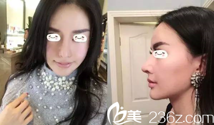 許琎院長(zhǎng)歪鼻修復(fù)案例