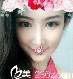 我對(duì)隆鼻后的外形不滿意，所以去韓國(guó)GAAM整形外科許琎那兒做了鼻失敗修復(fù)。