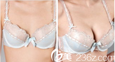 北京豐聯(lián)麗格王冀耕假體隆胸案例 北京豐聯(lián)麗格王冀耕假體隆胸案例