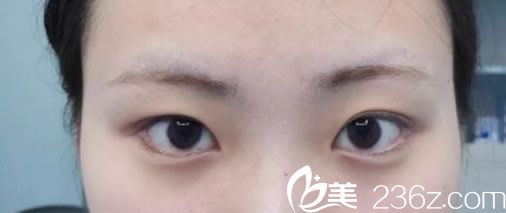 來福琳整形手術(shù)前 來福琳整形手術(shù)前