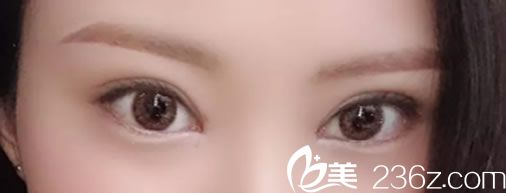 李榮鐘全切雙眼皮一個后恢復(fù)效果案例 李榮鐘全切雙眼皮一個后恢復(fù)效果案例