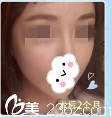 北京妹子選擇在韓國(guó)高蘭得整形外科做下頜角縮小手術(shù)，手術(shù)后兩個(gè)月對(duì)柳相旭院長(zhǎng)的技術(shù)真的是相當(dāng)佩服