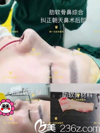 海南韓美網(wǎng)紅鼻打造手術(shù)中