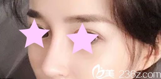 韓國來福琳整形醫(yī)院綜合隆鼻術(shù)后效果 韓國來福琳整形醫(yī)院綜合隆鼻術(shù)后效果