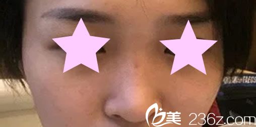 徐銀成院長鼻綜合手術(shù)前 徐銀成院長鼻綜合手術(shù)前