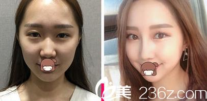 張宅鎮(zhèn)眼鼻整形案例 張宅鎮(zhèn)眼鼻整形案例