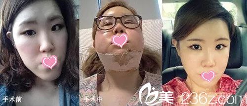 面部輪廓手術(shù)對比效果 面部輪廓手術(shù)對比效果