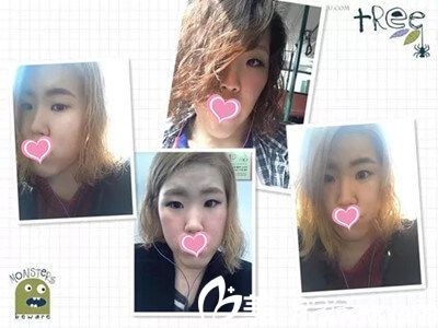 下頜角手術(shù)前照片 下頜角手術(shù)前照片