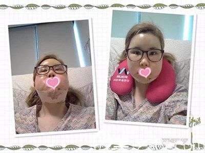 下頜角術(shù)后三天 下頜角術(shù)后三天