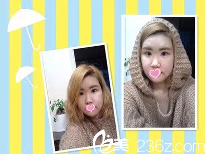 在韓國原辰做面部輪廓手術(shù)兩周了