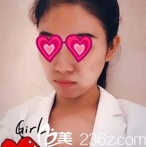 全面部祛痘美膚術后半個月 全面部祛痘美膚術后半個月