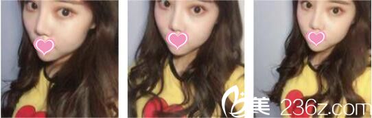 分享三個(gè)月前我在韓國(guó)UNIMEDI整形外科找尹仁模做的韓式雙眼皮+假體隆鼻恢復(fù)過(guò)程