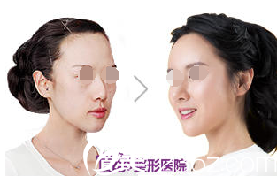 全胤株院長(zhǎng)MISKO隆鼻整形案例