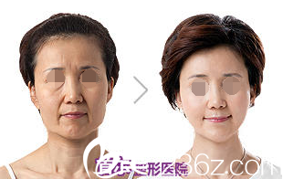 臉部脂肪移植術(shù)案例