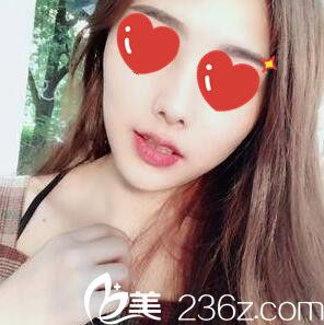 在長沙臉博士<!--<i data=20240703-sp></i>-->做鼻綜合術后半個月效果 在長沙臉博士<!--<i data=20240703-sp></i>-->做鼻綜合術后半個月效果