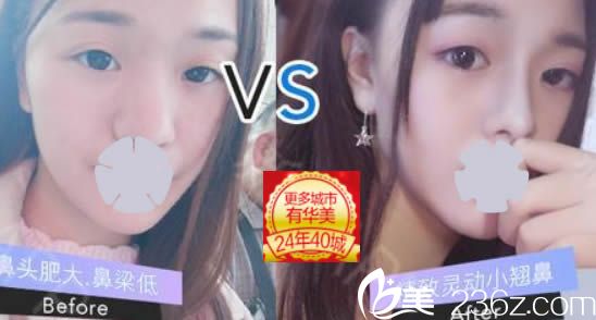 廈門華美整形隆鼻效果對比圖 廈門華美整形隆鼻效果對比圖