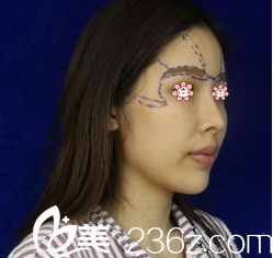 我的術(shù)前照片 我的術(shù)前照片