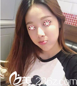 何山自體脂肪填充太陽穴術(shù)后一周 何山自體脂肪填充太陽穴術(shù)后一周