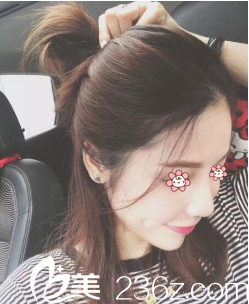 烏魯木齊伊麗莎白整形自體脂肪面部填充術(shù)后半個(gè)月 烏魯木齊伊麗莎白整形自體脂肪面部填充術(shù)后半個(gè)月