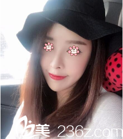 烏魯木齊伊麗莎白整形何山是在我大腿抽脂做的自體脂肪填充太陽穴和額頭。