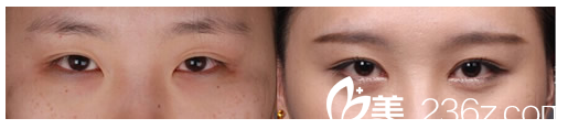 開(kāi)眼角手術(shù)案例對(duì)比圖