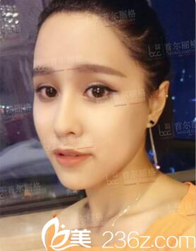 選擇韓國毛理醫(yī)院植發(fā)拯救我的大M額頭