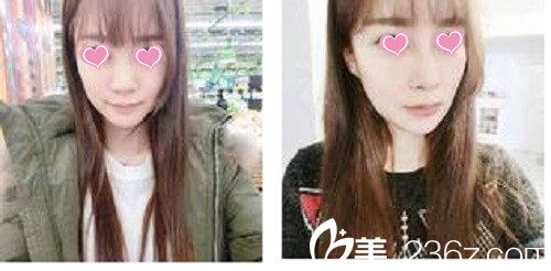 韓國星期八整形外科·皮膚科隆鼻手術(shù)案例