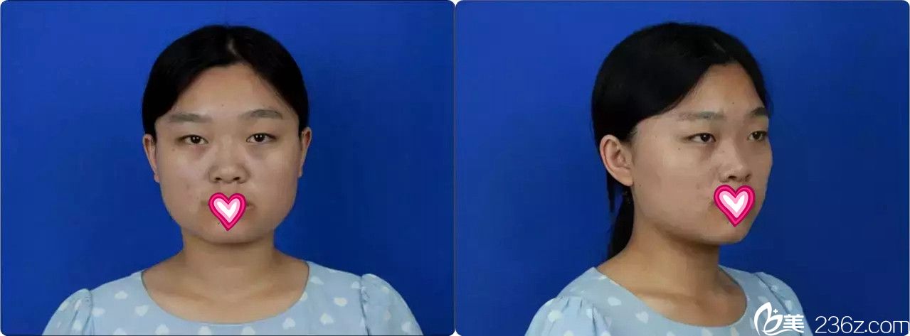 術(shù)前樣子普通想做雙眼皮和改臉型 術(shù)前樣子普通想做雙眼皮和改臉型