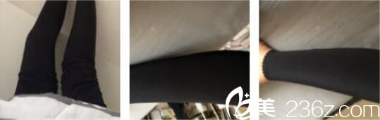 韓國(guó)Valinew抽脂好不好？看申怡暻為我做的抽脂瘦小腿術(shù)后三個(gè)月效果圖