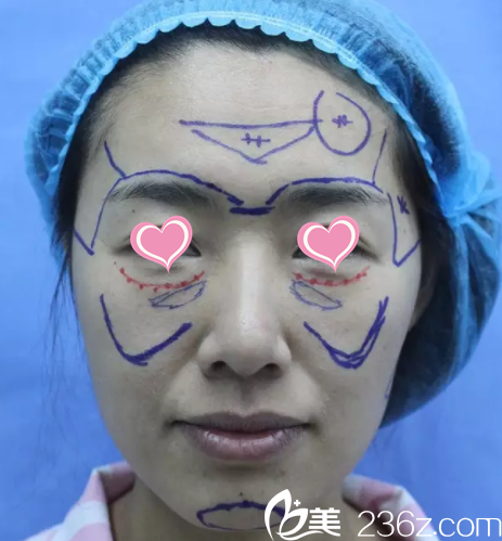 魯禮新給我做面部脂肪填充設(shè)計(jì)照