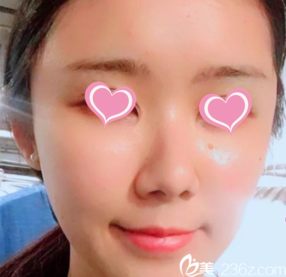 北京葉子面部脂肪填充案例