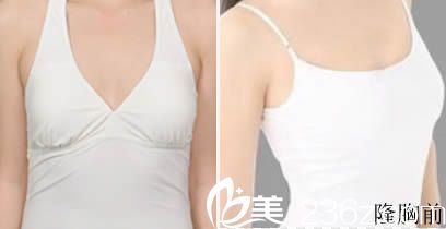 韓國(guó)id整形做假體隆胸術(shù)前照 韓國(guó)id整形做假體隆胸術(shù)前照