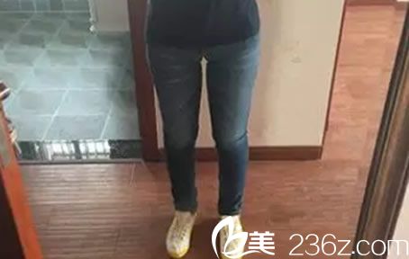 吸脂后15天后恢復(fù)效果 吸脂后15天后恢復(fù)效果