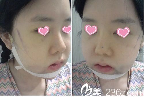 下頜角手術(shù)后3天