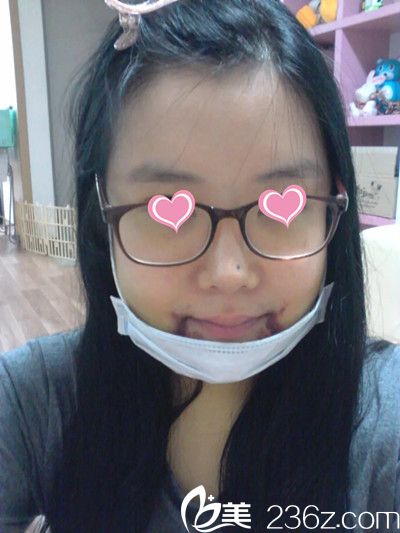 顴骨手術(shù)后10天